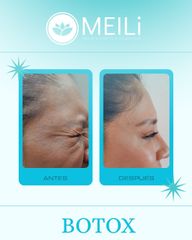 Toxina Botulinica - MEILi Rejuvenecimiento