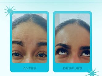Toxina botulínica antes y después - 878713