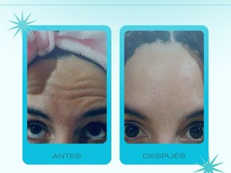 Toxina botulínica antes y después - 878714