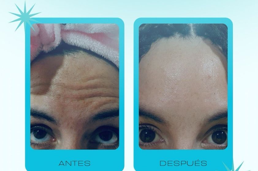 Toxina botulínica antes y después - 878714
