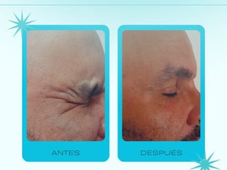 Toxina botulínica antes y después - 878715
