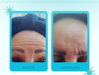 Toxina botulínica antes y después - 878716