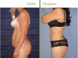 Lipoescultura