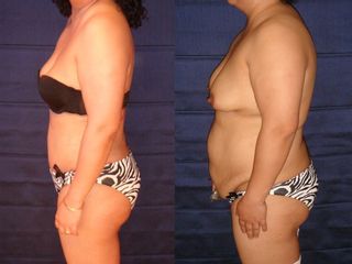 Dermolipectomia o Tummy Tuck
