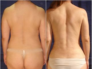 Antes y después de Mommy Makeover