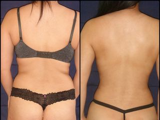 Antes y después de Liposucción