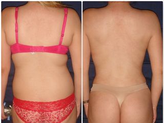 Antes y después de Lipoescultura