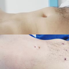 Liposucción - Dr. Marcelo Ruiz Siller
