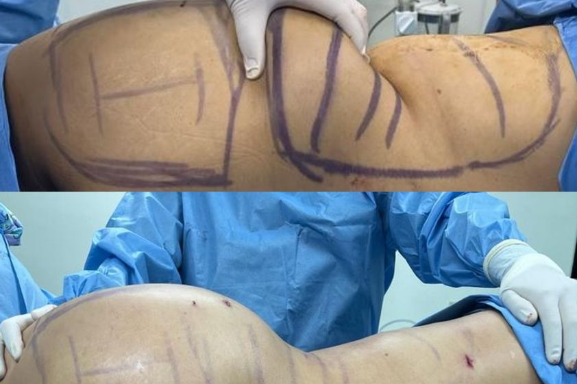 Liposucción antes y después - 853547
