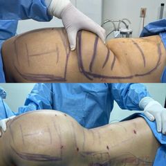 Liposucción - Dr. Marcelo Ruiz Siller