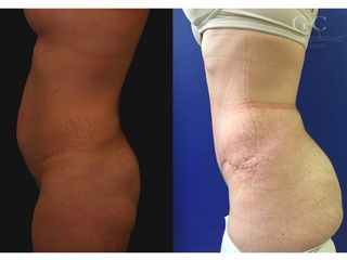 Antes y después de  Lipectomía Caso 1 
