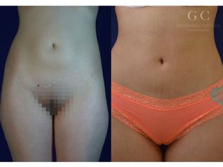 Antes y después de  Lipo Caso1 