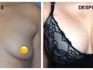 Antes y despues de aumento de senos