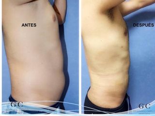 Antes y después de resección de Ginecomastia + Liposucción de Abdomen y Espalda. 
