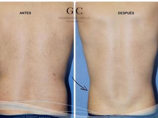 Antes y después de liposucción