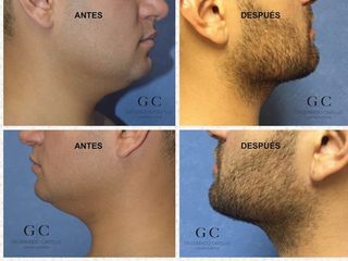 Antes y después de liposucción de cuello