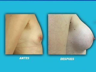 Antes y después de aumento de senos