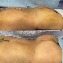 Antes y después de Transferencia Glútea de grasa con liposucción HD