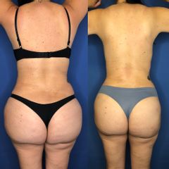 Antes y después de Liposucción corporal HD y Reducción glútea 