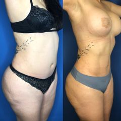 Antes y después de Liposuccion HD 