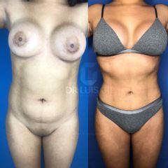 Antes y después de Liposucción HD
