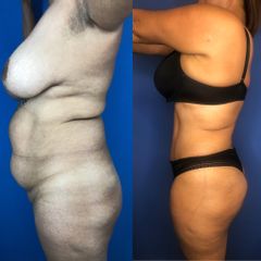 Antes y después de Liposucción HD mas Abdominoplastia