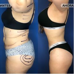 Antes y después de Liposucción de alta definición