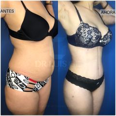 Antes y después de Abdominoplastia con liposuccion HD 