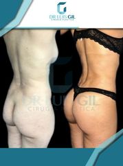 Antes y después de Lipotransferencia