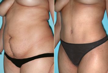 Antes y después de Abdominoplastia