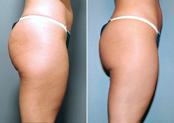 Antes y después de Liposucción