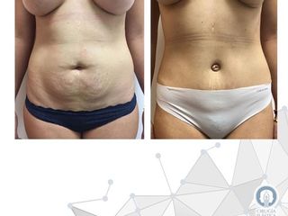 Antes y después Liposucción