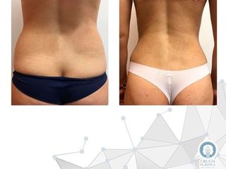 Antes y después de liposucción