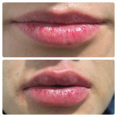 Aumento de labios - Dra. Maxin Arizmendi