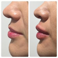 Aumento de labios - Dra. Maxin Arizmendi