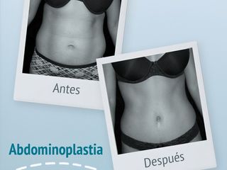 Antes y después de abdominoplastia