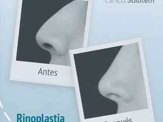 Antes y después de rinoplastia