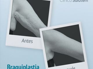 Antes y después de braquiplastia