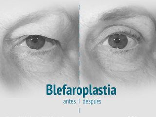 Antes y después de blefaroplastia