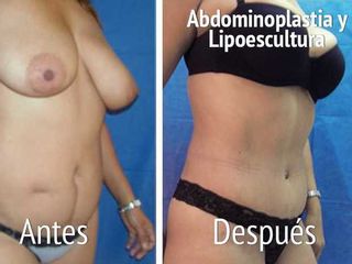 Antes y después de abdominoplastia y lipoescultura