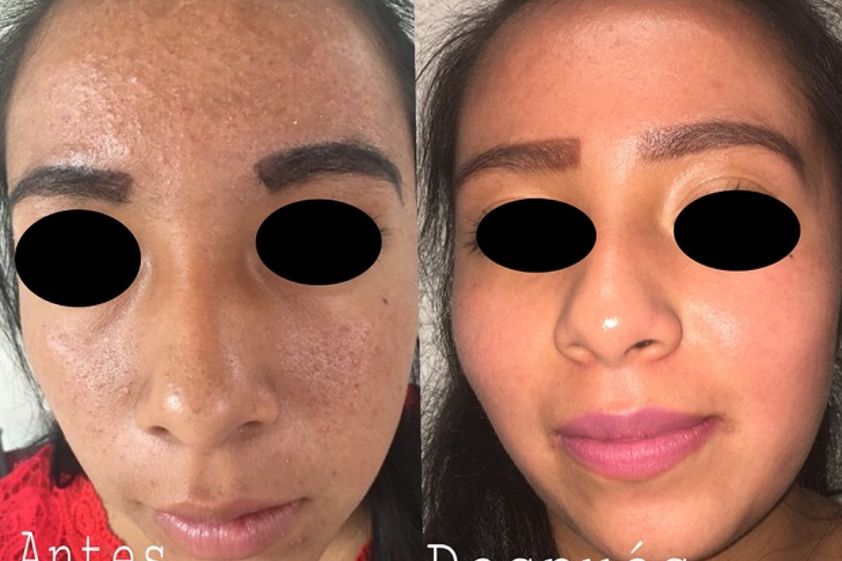 Peeling antes y después - 592259