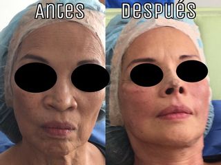 Antes y después de Hilos en rostro y nariz