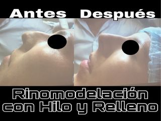 Antes y después de Rinomodelación con hilo y relleno de ácido hialurónico