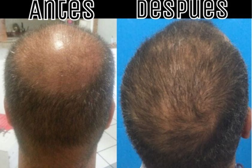 Alopecia antes y después - 594285