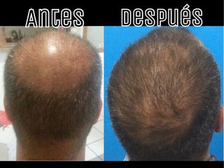 Antes y después de Tratamiento de alopecia