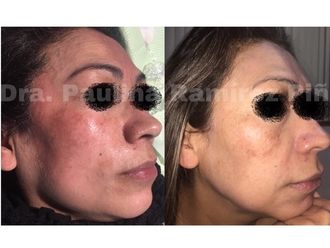 Manchas en la Piel - 619243