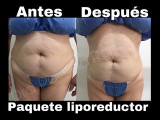 Antes y después de tratamiento liporeductor