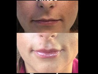 Antes y después de Relleno de Labios con Ácido Hialurónico