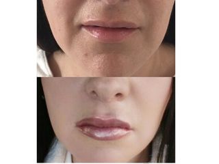 Antes y después de Relleno de labios con Acído Hialurónico 