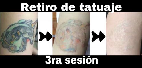 Antes y después de Eliminación de Tatuaje